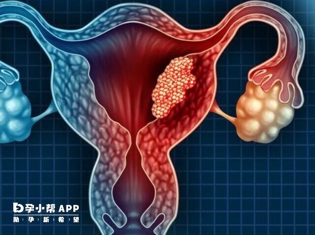 女性患有多囊卵巢的症状