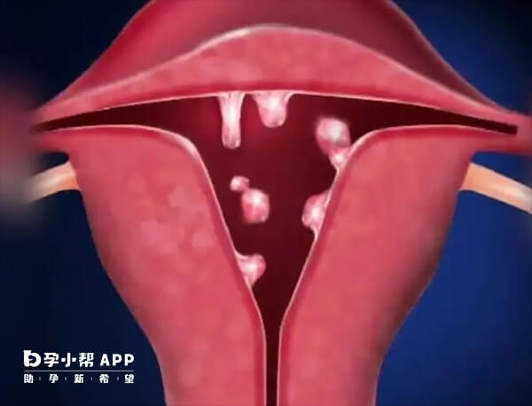 严重的宫颈息肉会影响胚胎移植的着床