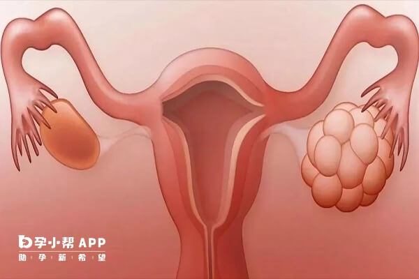月经不调是多囊卵巢的症状之一