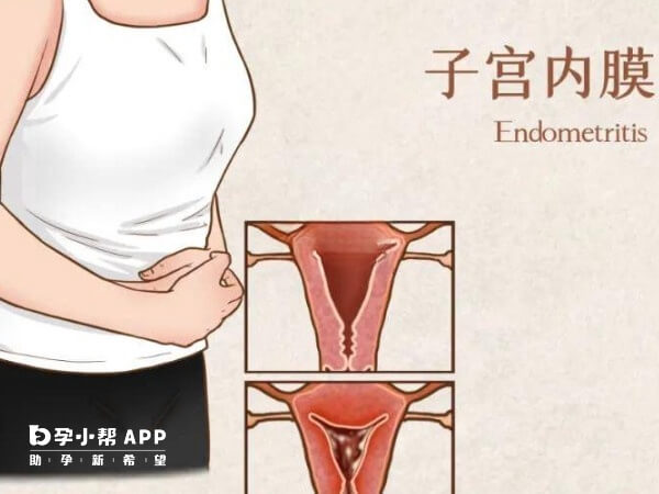 子宫内膜感染也会导致宫腔粘连