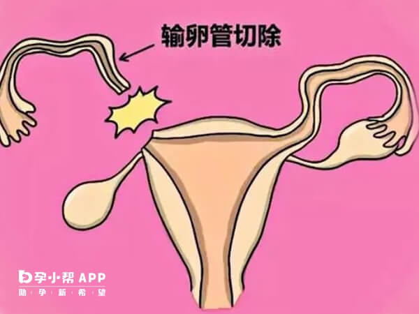 只有一侧输卵管通过一些方法能怀孕