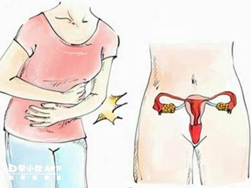 子宫腺肌症的备孕方法