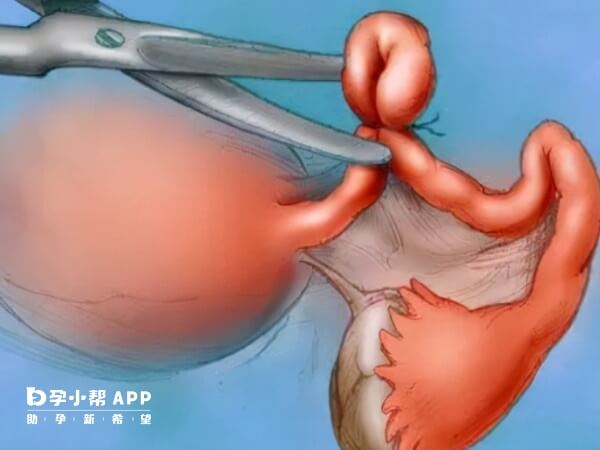 输卵管结扎最好选择壶腹部利于修复