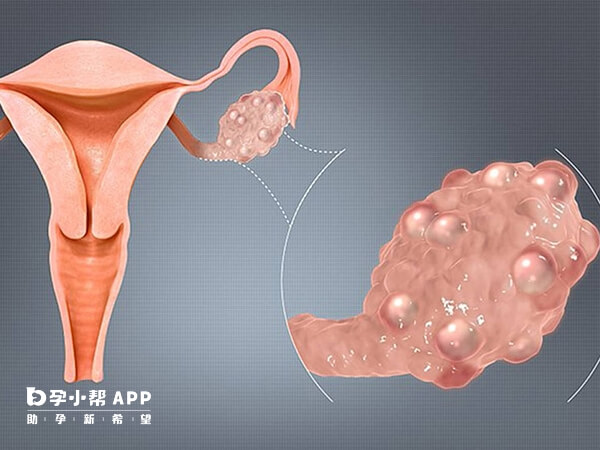 输卵管积水常见原因是病毒细菌感染和炎症