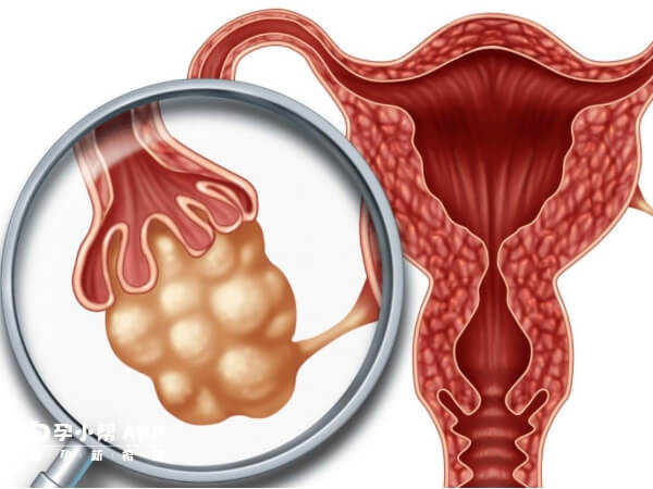 多囊卵巢不孕的治疗方法