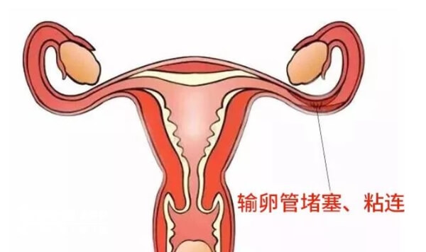 输卵管粘连宫内孕的几率