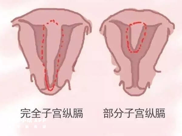 严重纵隔子宫不做手术容易反复流产