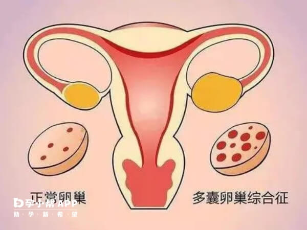 多囊卵巢不治疗拖严重后可能会患癌