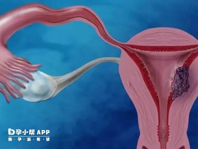 药物和手术治疗是宫腔粘连的常见方法