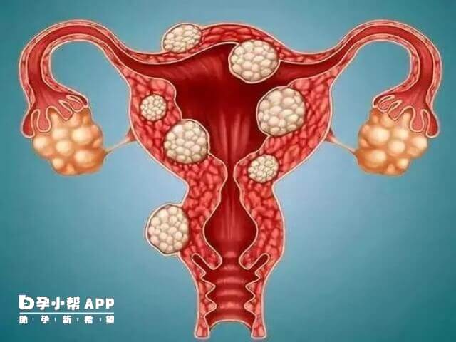 患有子宫肌瘤可同时出现多个症状表现