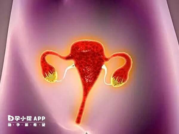 子宫内膜异位症长期不治会导致不孕