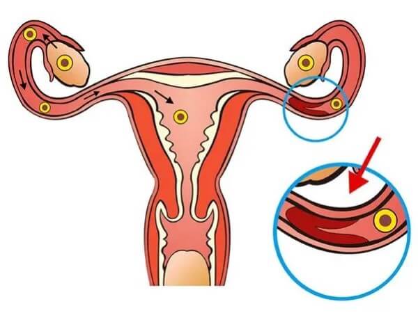 月经不调是输卵管堵塞的症状