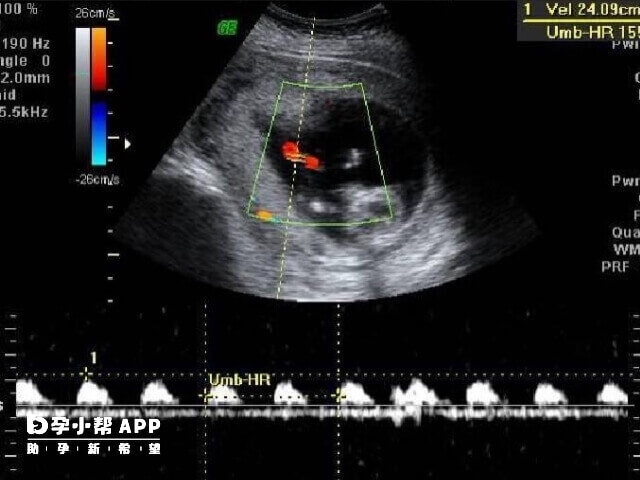 超声检测法算排卵期最准确