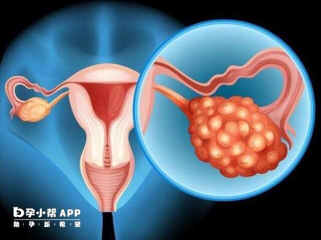多囊卵巢会影响卵泡发育成熟