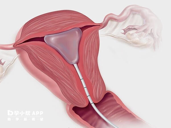 积极治疗可预防宫腔粘连