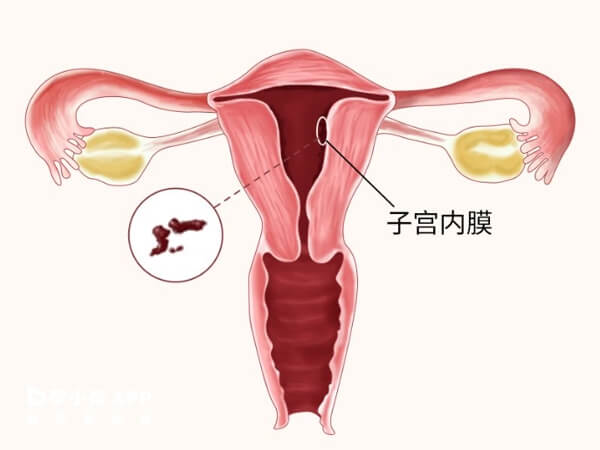 适中的子宫内膜厚度对于怀孕非常重要