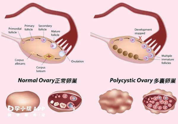 多囊卵巢会导致月经不调