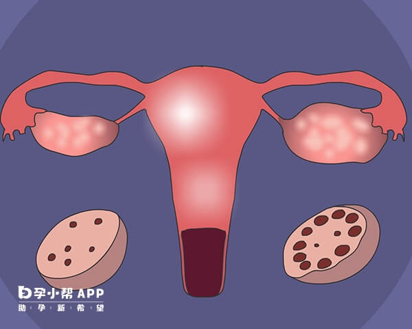 多囊卵巢综合症怀孕的机率小