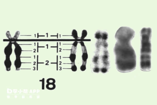 胎儿18号染色体三体一定要积极治疗