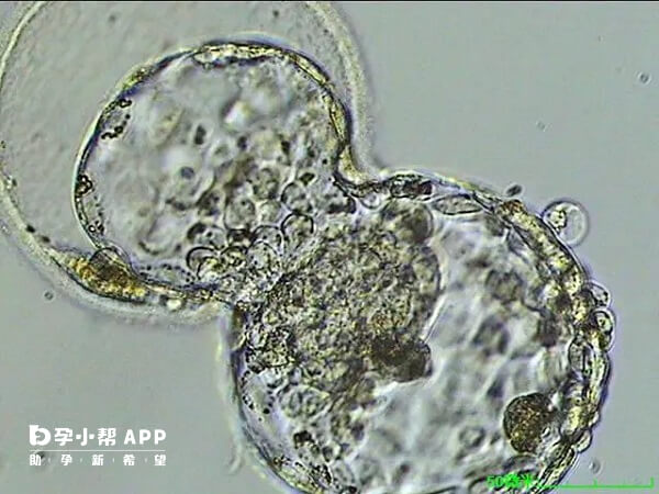 囊胚移植数量不能决定试管婴儿成功率