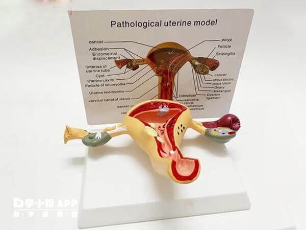 始基子宫是子宫畸形类型的一种