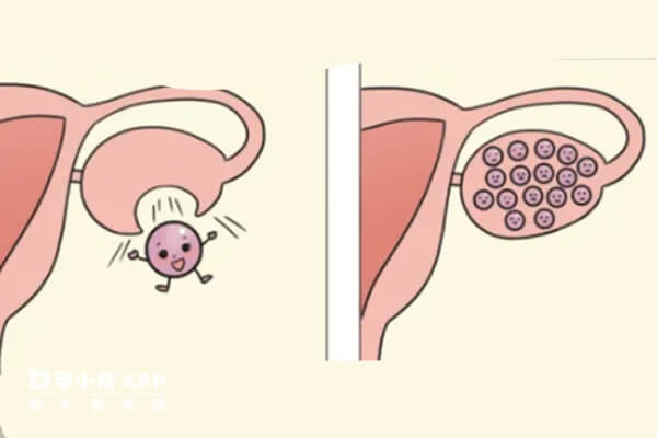 多囊在做试管婴儿前要先治疗改善