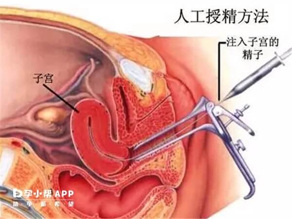 人工授精成功率在20%-30%之间