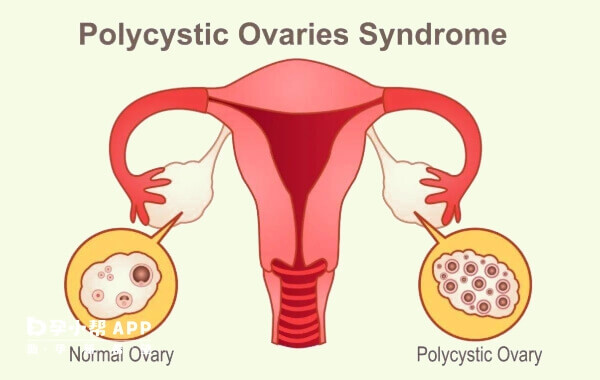 内分泌调节是治疗多囊卵巢的方式之一