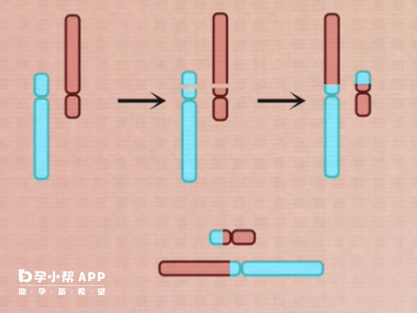 罗氏易位是一种较为复杂的染色体异常