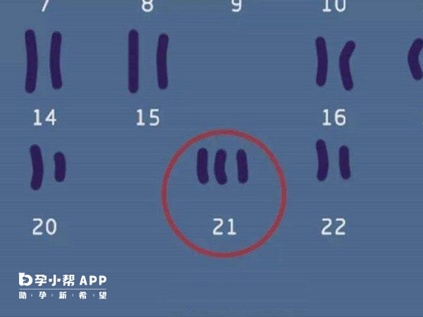 21号染色体异常的宝宝称为唐氏宝宝