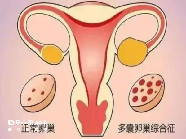 多囊患者可以根据医生建议选促排方案