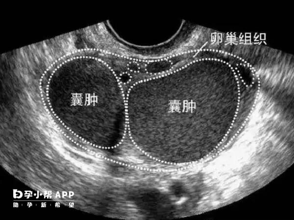 卵巢囊肿手术后多补充营养