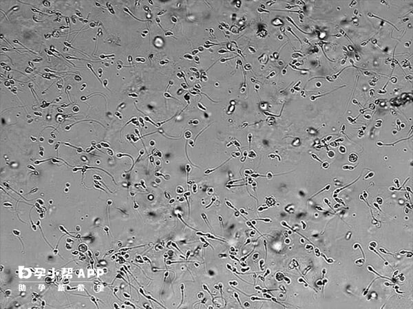 想治愈死精症得明确病因