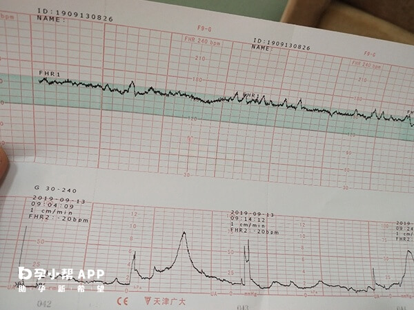 胎心基线是否达标对胎儿健康很重要