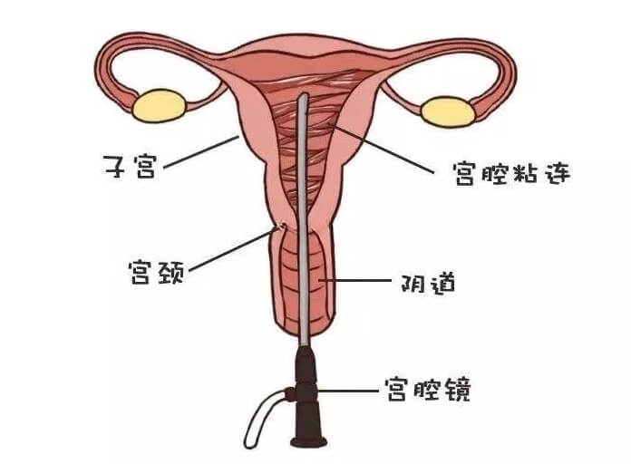 宫腔镜检查能确保子宫内环境