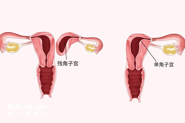 子宫畸形属于先天生殖道畸形