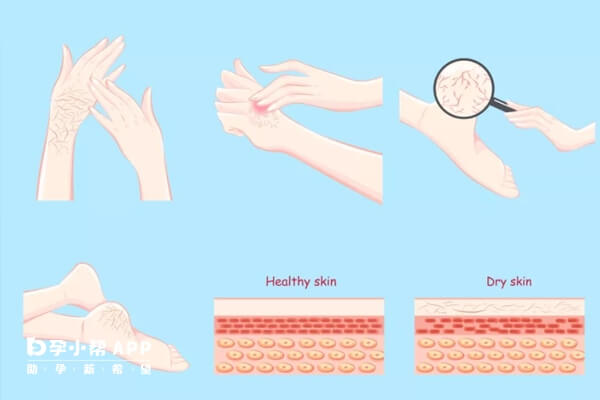 鱼鳞病典型表现是皮肤干燥