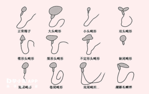 畸形精子会拉低胚胎质量影响怀孕