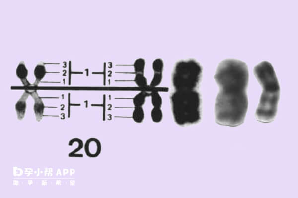 20号染色体异常胎儿可能给家庭带来负担