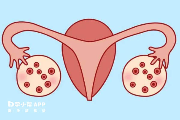 多囊促排卵过度会适得其反