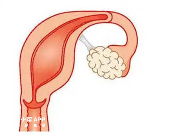 单角子宫药物治疗后可改善子宫内环境