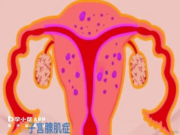 女性闭经早对腺肌症有好处