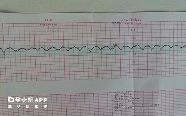 胎心监护在孕晚期也是非常重要的