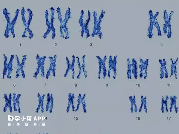 夫妻生过畸形儿要做染色体检查