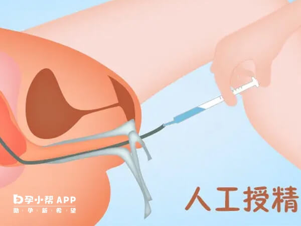 非正规人工授精治疗可能影响患者健康