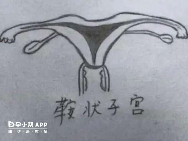 弓形子宫只对女性生育有较大影响