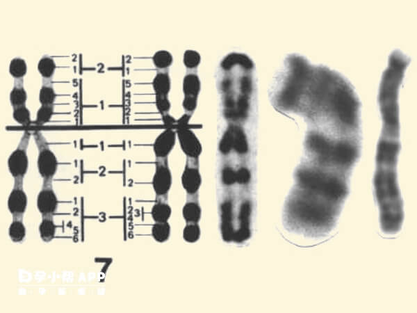 胎儿7号染色体缺失对生活影响较大