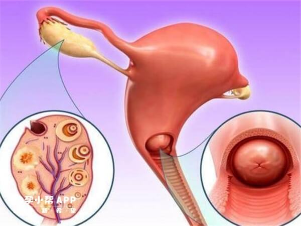 宫颈炎不利于受精卵着床