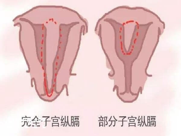 纵隔子宫切除后可能会损伤宫腔影响移植