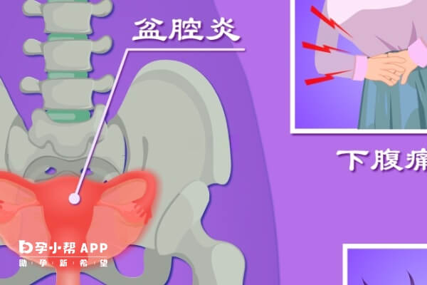 盆腔炎不治疗会干扰三代试管成功率